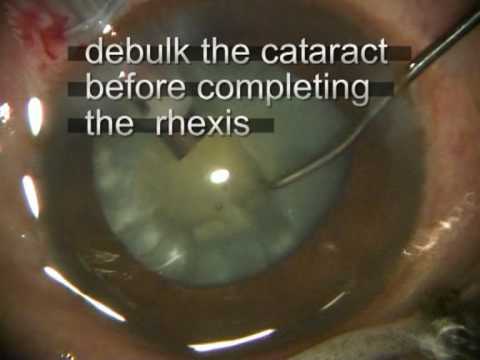Phaco Needle Rhexis in hypermature white cataract - YouTube