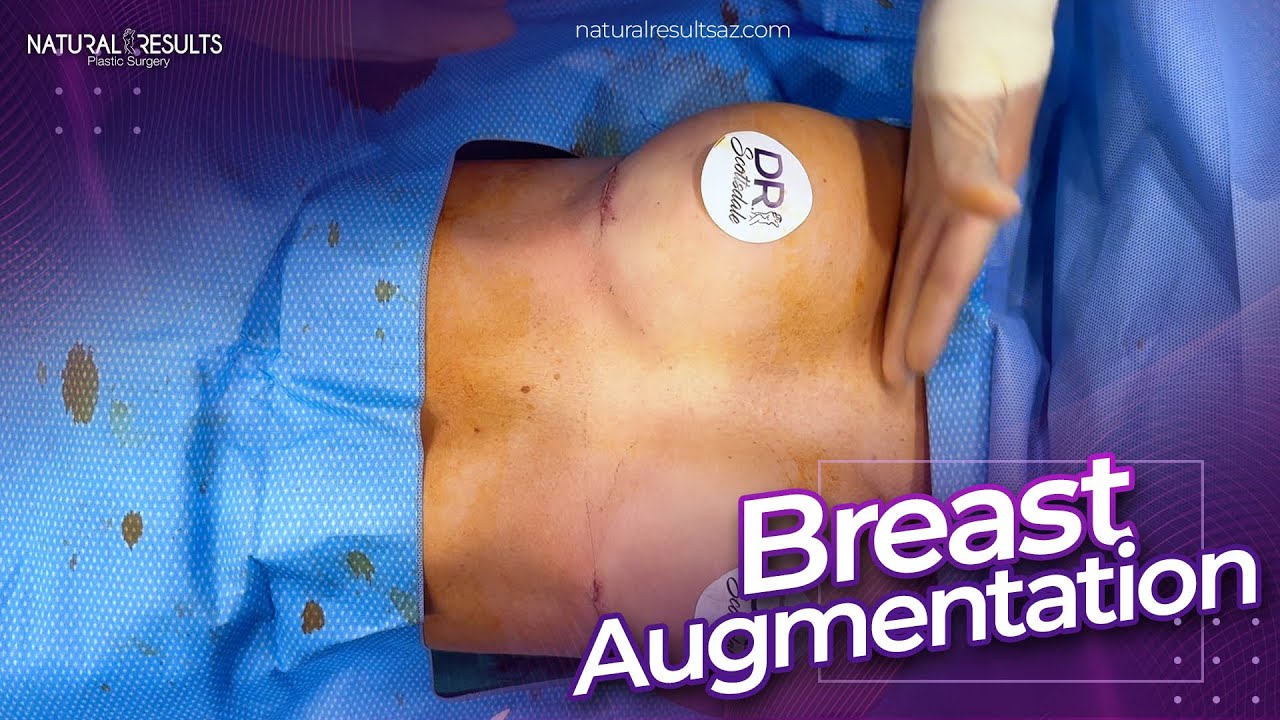 Rapid Recovery Breast Augmentation | Dr.Scottsdale - YouTube
