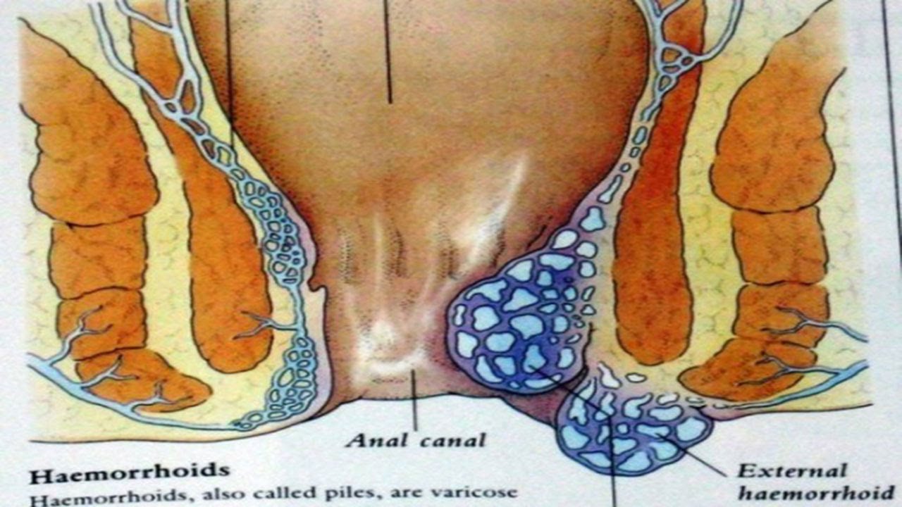 Cara Menyembuhkan Ambeien Dalam