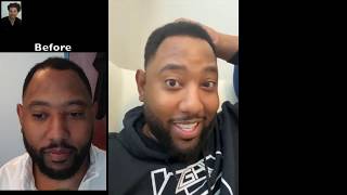 Fort Lauderdale Hair Transplant Clinic | Permanent Hair Restoration for Black Men