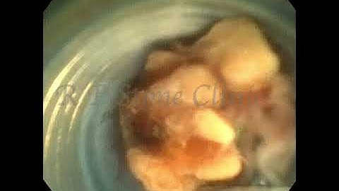 Stone Lased in Access Sheath During RIRS