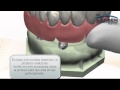 Reponer toda la boca con implantes dentales - All-on-four