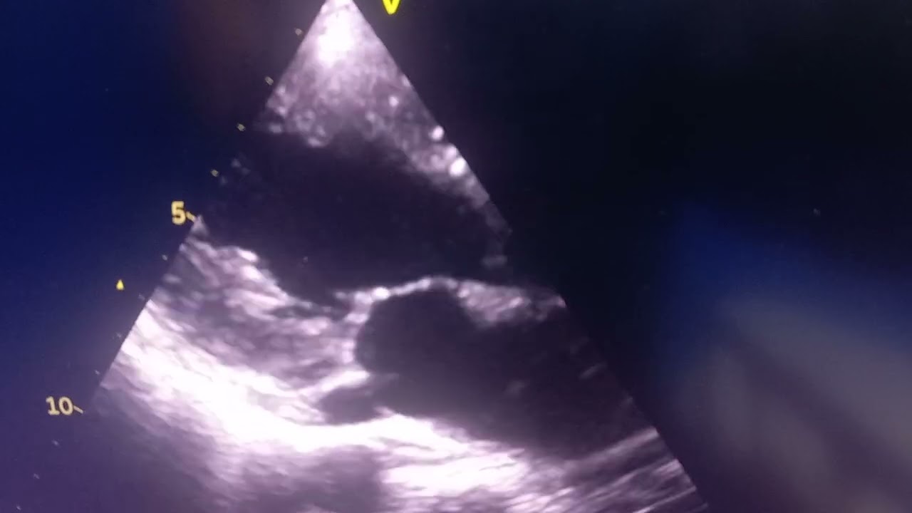 Dilated coronary sinus 