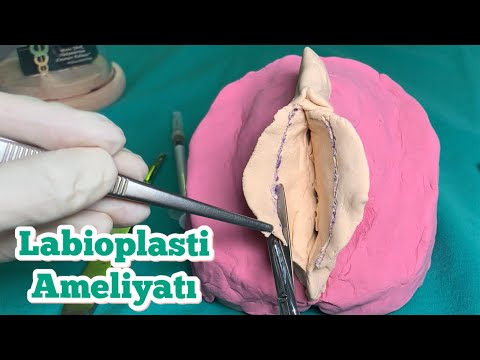 Labioplasti Ameliyatı (Vajina ve İç Dudak Estetiği) Nasıl Yapılır? Uç ve Wedge Rezeksiyon Nedir?