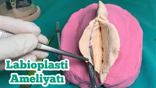 ✂️ Labioplasti Ameliyatı (Labiaplasty Surgery) Antalya Turkey - İç Dudak Estetiği Nasıl Yapılır?