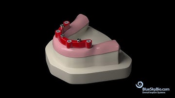 UCLA Overdenture Bar