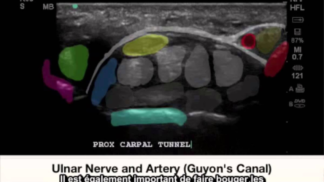 Tude de cas SonoSite FujiFilm Canal carpien Nerf mdian bifide