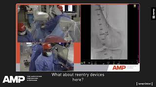 How do you tackle re-entry in complex peripheral cases?