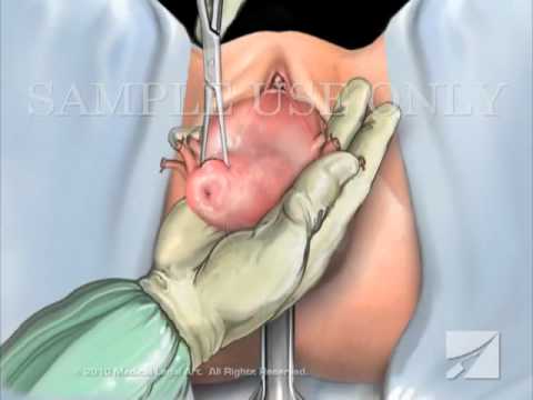 Laparoscopic Assisted Vaginal Hysterectomy (LAVH)