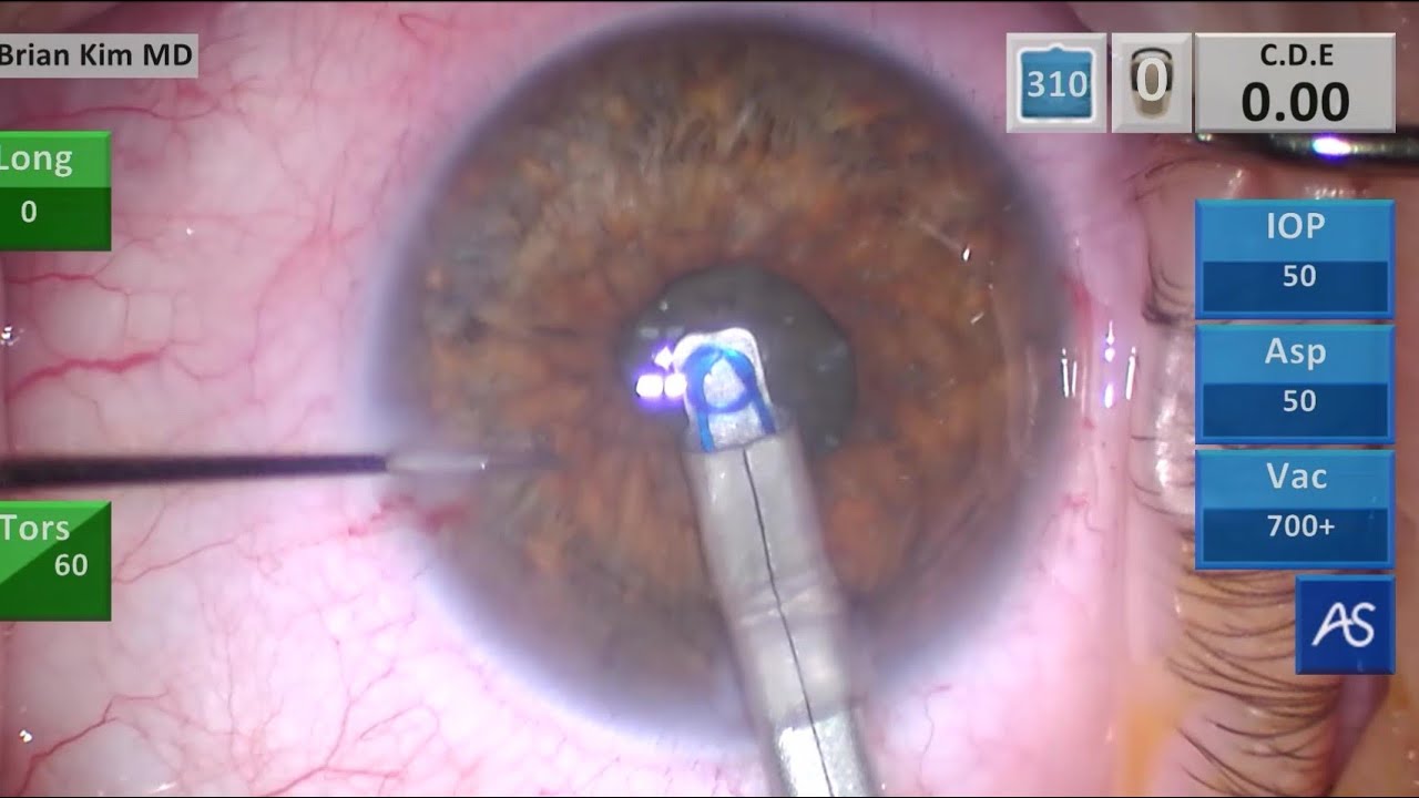 Use of Malyugin Pupil Expansion Ring in Femtosecond Laser-assisted Cataract  Surgery