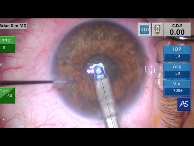 Arquivos Brasileiros de Oftalmologia - Efficacy of the Canabrava Ring  (pupil expansion device) in cataract surgery for eyes with small pupils:  the first 30 cases