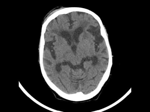 gliosis definicion