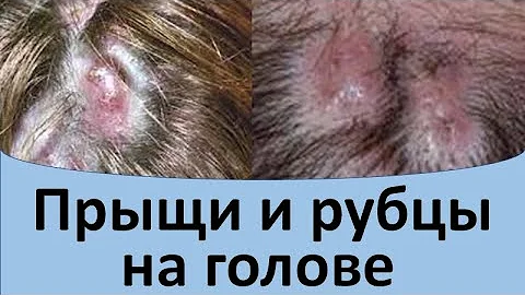 Прыщи и рубцы на голове