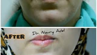 MyoModulation For DAO Using HA And Chin Tox - Dr. Noury Adel