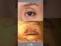 눈위꺼짐 리얼 환자 치료 경과 (4개월 후) #shorts