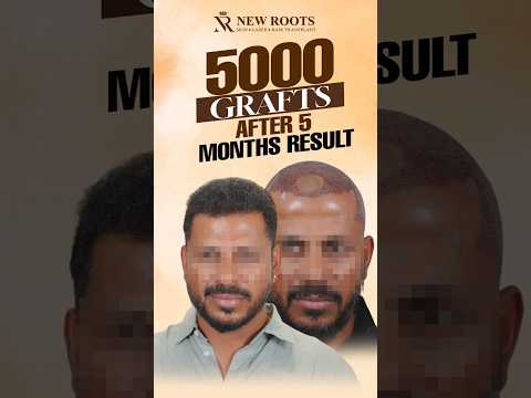 5000 Grafts Hair Transplant in Kolhapur | Natural Hairline #naturalhairline #viral #shorts