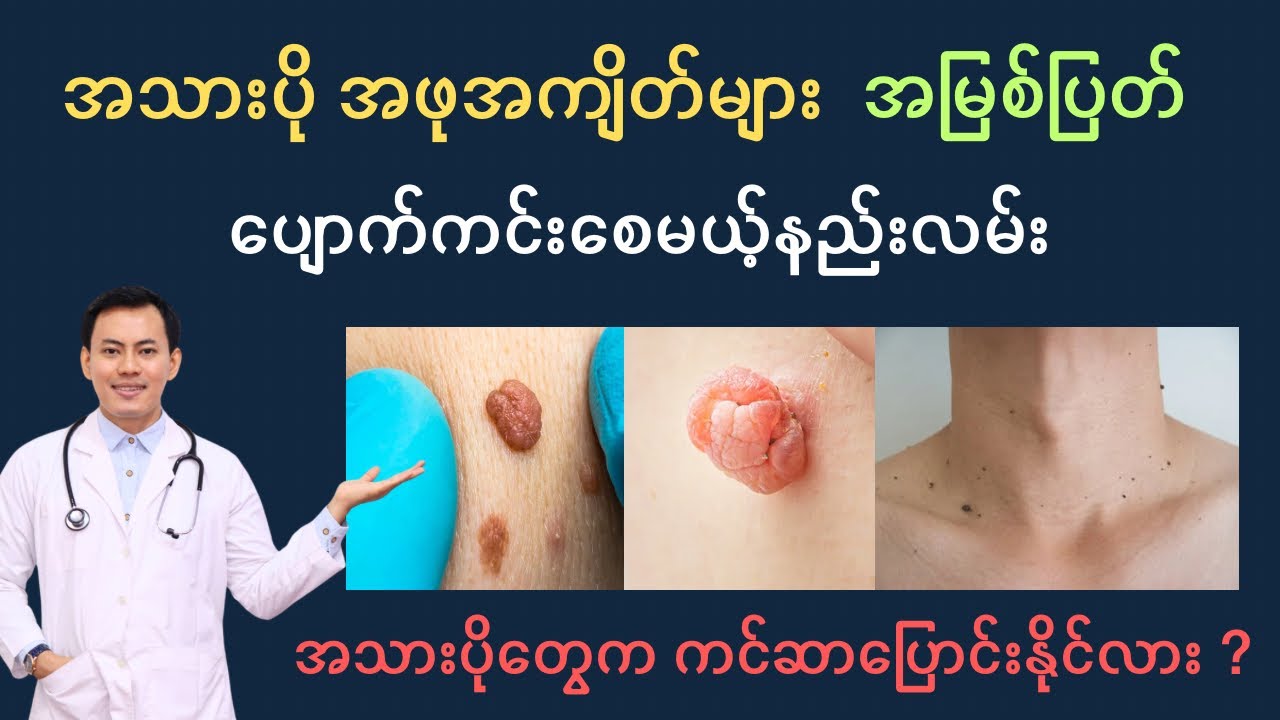 အသားပို အဖုအကျိတ်များ အမြစ်ပြတ်ပျောက်ကင်းစေမယ့် နည်းလမ်းနှင့် ကင်ဆာပြောင်းနိုင်လားဆိုတာ ပြောပြထားသည်