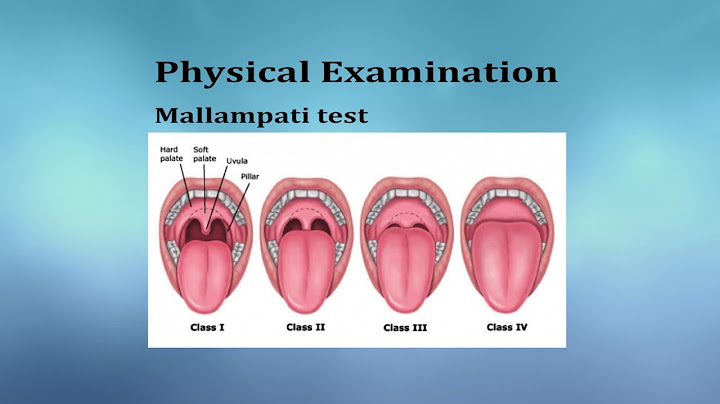 Đánh giá mallampati