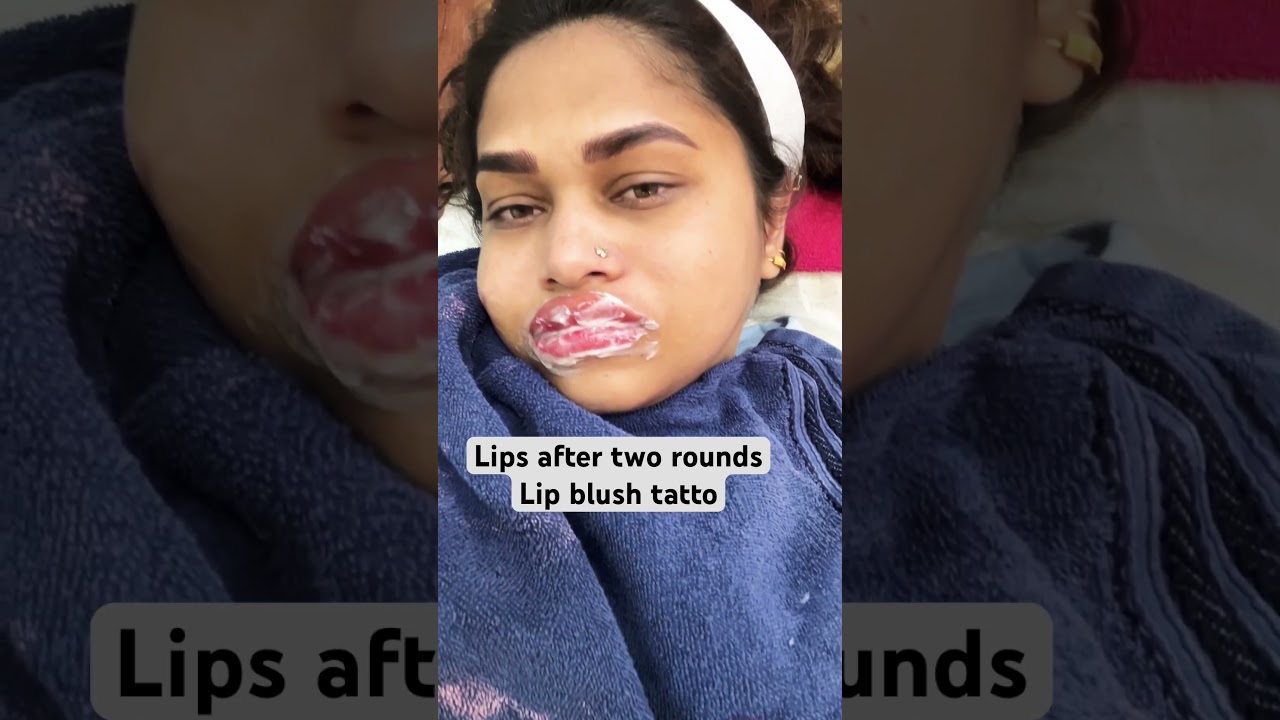 Apply numbing cream for the 3rd round as pain’s unbearable. 