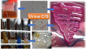 Come si prende la Klebsiella nelle urine?