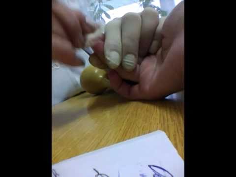 Дуплексное ангиосканирование вен нижних конечностей