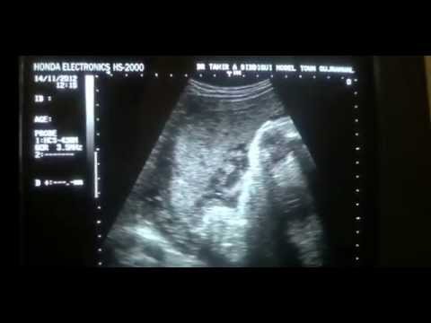 Video: Ano ang Grade 1 placenta?