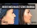 COMO MUDEI MEU NARIZ SEM CIRURGIA (Tudo sobre minha Rinomodelação) - Viihrocha