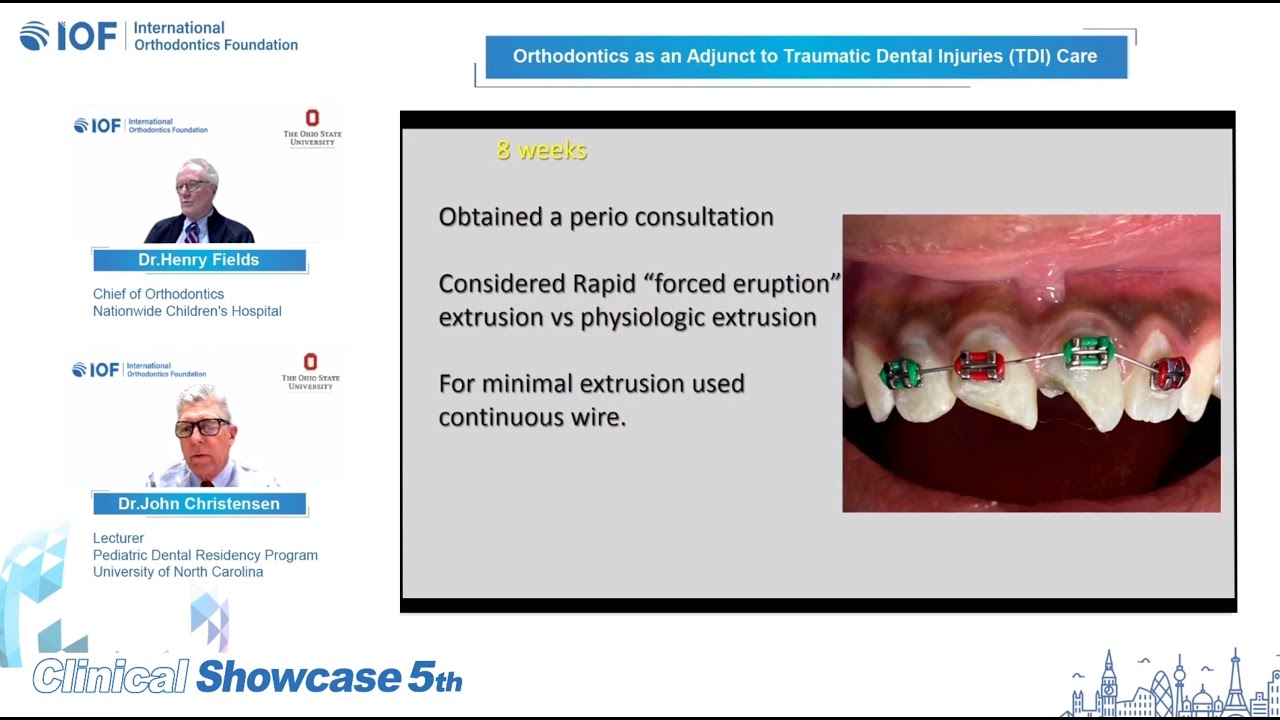 IOF Clinical Showcase 5 — Preventive Orthodontic Treatment - YouTube