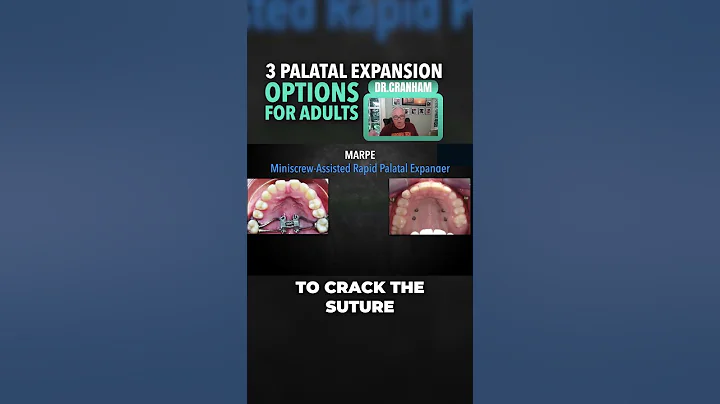 3 Palatal Expansion Options for Adults