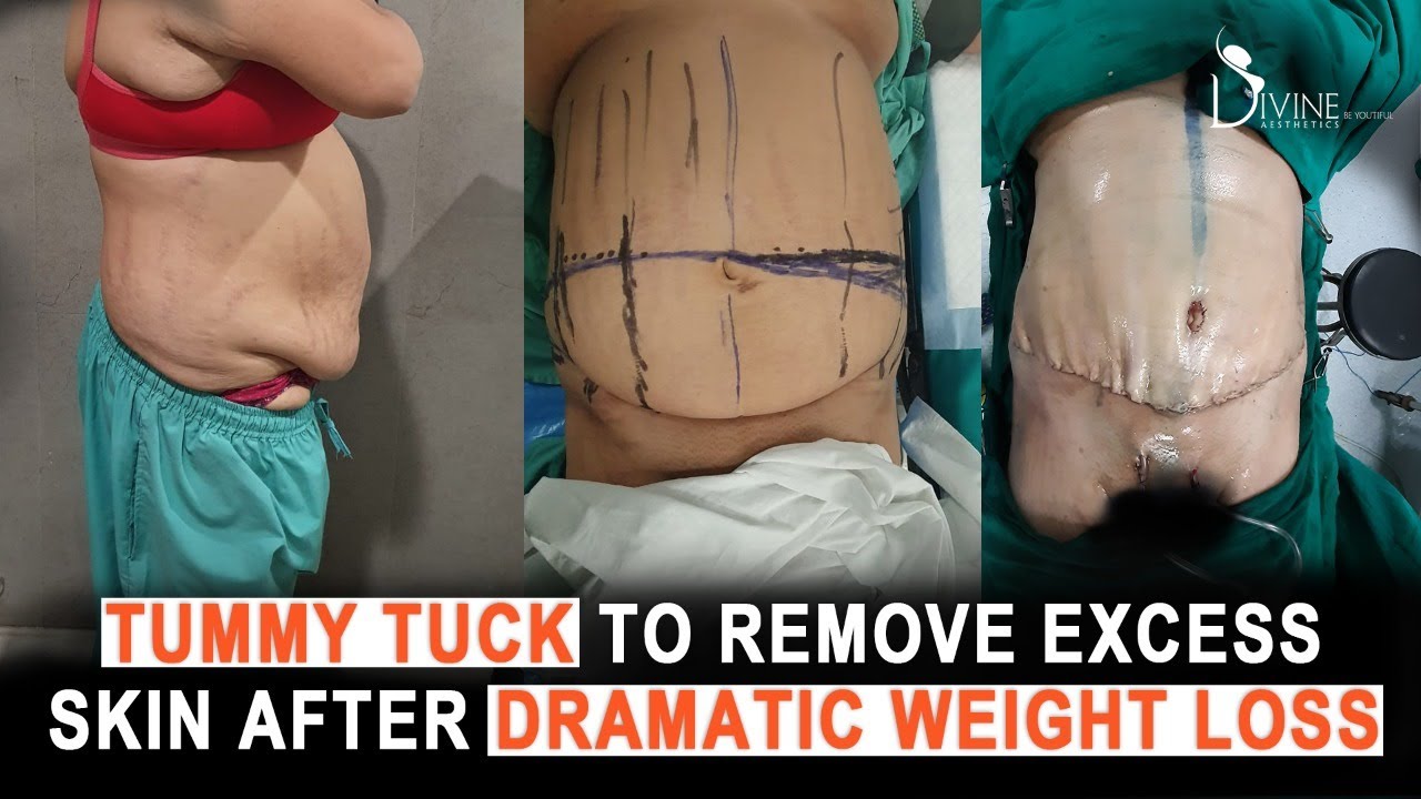 Weight Loss After Tummy Tuck Photos