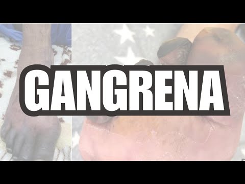 Video: Cómo tratar la gangrena seca (con imágenes)