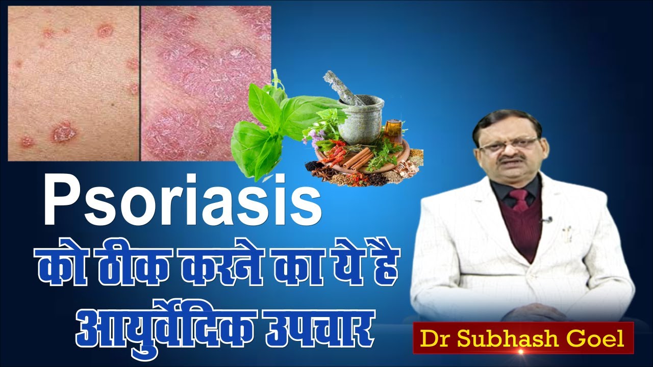 Psoriasis को ठीक करने का ये है आयुर्वेदिक उपचार। Subhash Goyal। Sadhna TV