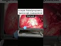 Save your organs—and yourself—from big incisions. Choose laparoscopic (minimally invasive) surgery
