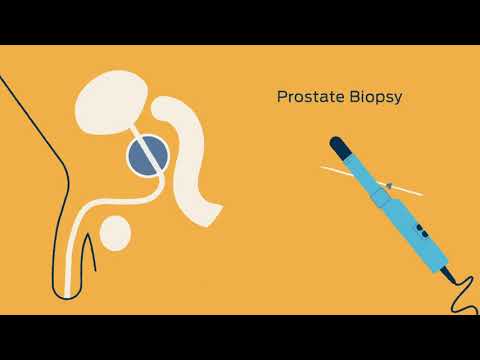 Tests to Diagnose and Monitor Prostate Cancer