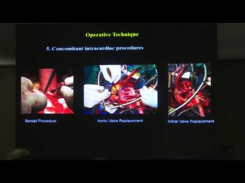 VASCULAR SYMPOSIUM: THORACOABDOMINAL AORTA