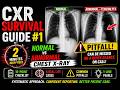 X-RAY Cases and Basics Series: Normal vs Abnormal Chest X-Ray: Systematic Approach &amp; Common Pitfalls