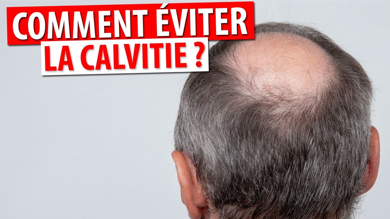 COMMENT PRÉVENIR OU ÉVITER LA CALVITIE ? YouTube — free download