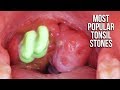 Most Popular Tonsil Stone Removals on YouTube!