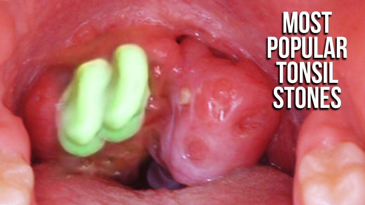 tonsil stone removal