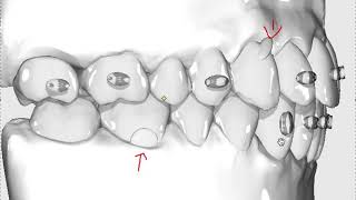 Precision cuts now available on white label aligners, Class 2, Class 3