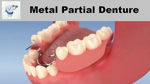 Metal Partial Denture Animation