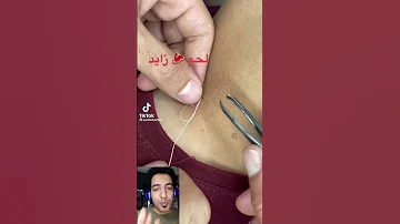اسرع علاج منزلي للتخلص من الزوائد الجلدية من غير ضرر ولا مشاكل نهائيا حلاقين مصر 