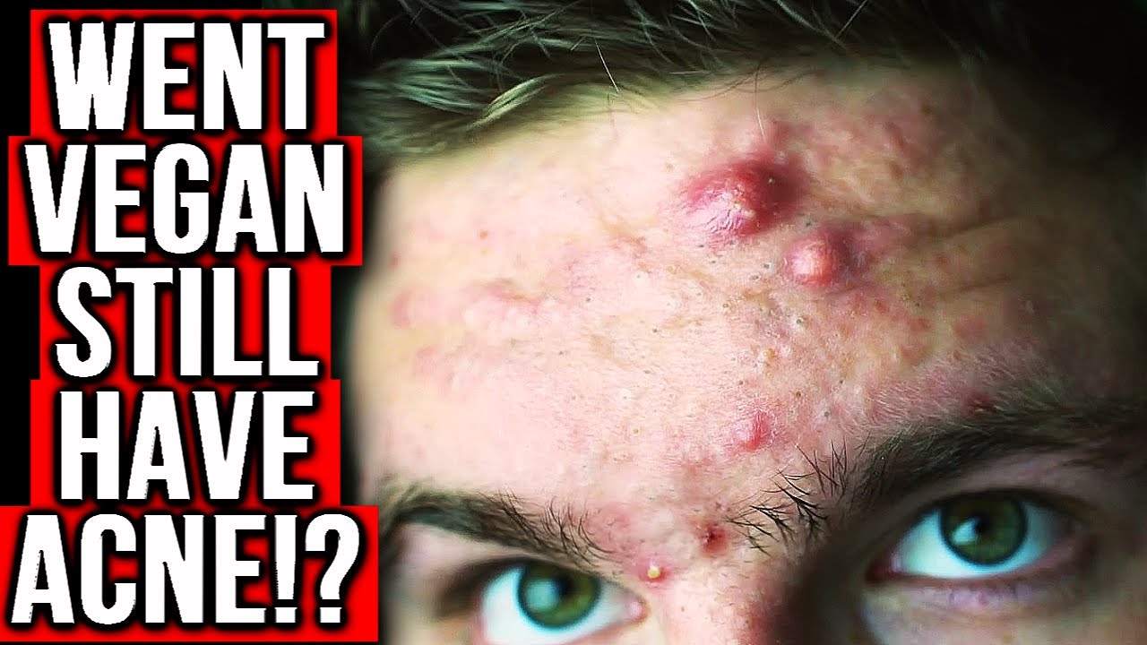 TOP 7 VEGAN FOODS THAT CAUSE ACNE YouTube