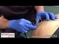 Dry Needling On A Weightlifter&#39;s Shoulder