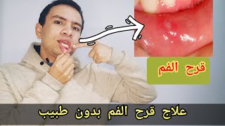 8 طرق سحريه لعلاج قرح الفم و اللسان في المنزل بدون طبيب