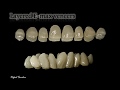 Emax veneers #14-24