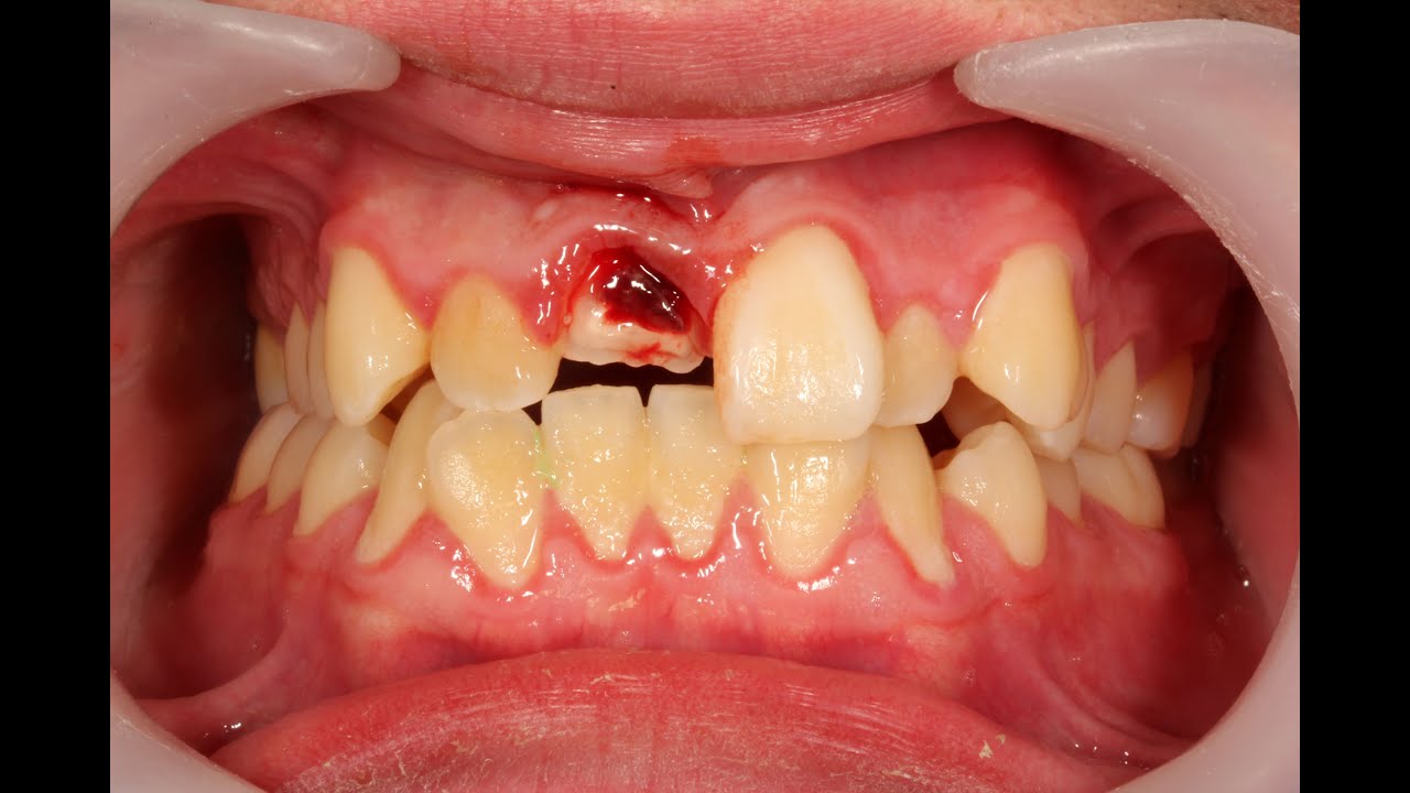 Abgeschlagener Schneidezahn Was Tun Erstversorgung Und