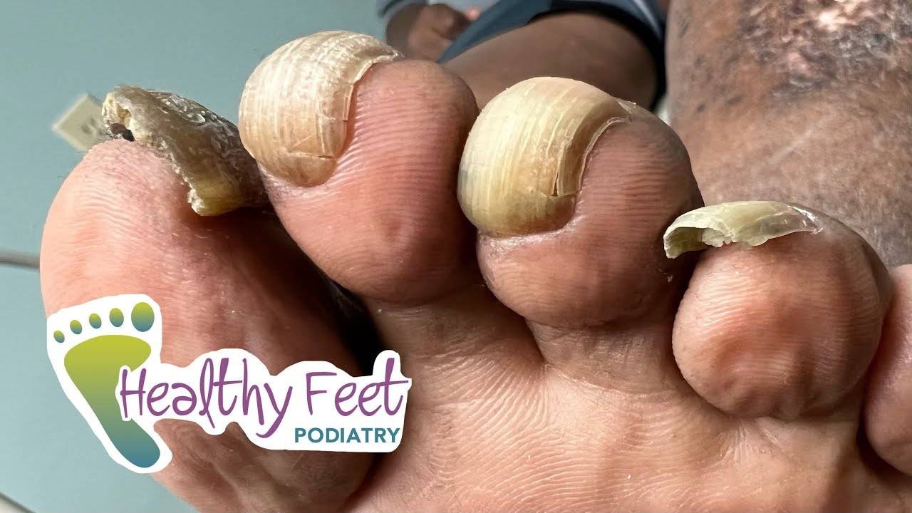 NAILS KEEP GROWING INTO THE SKIN! YouTube