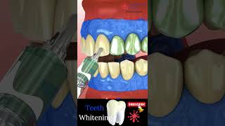 Instant Teeth Whitening 😬 Teeth Care 🪥 Dental Clinic 🦷 Medical Animation