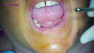 ALL IN ONE surgery demonstration V7